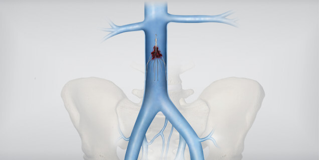 Clot_Filter_636x320