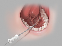 Dilator
