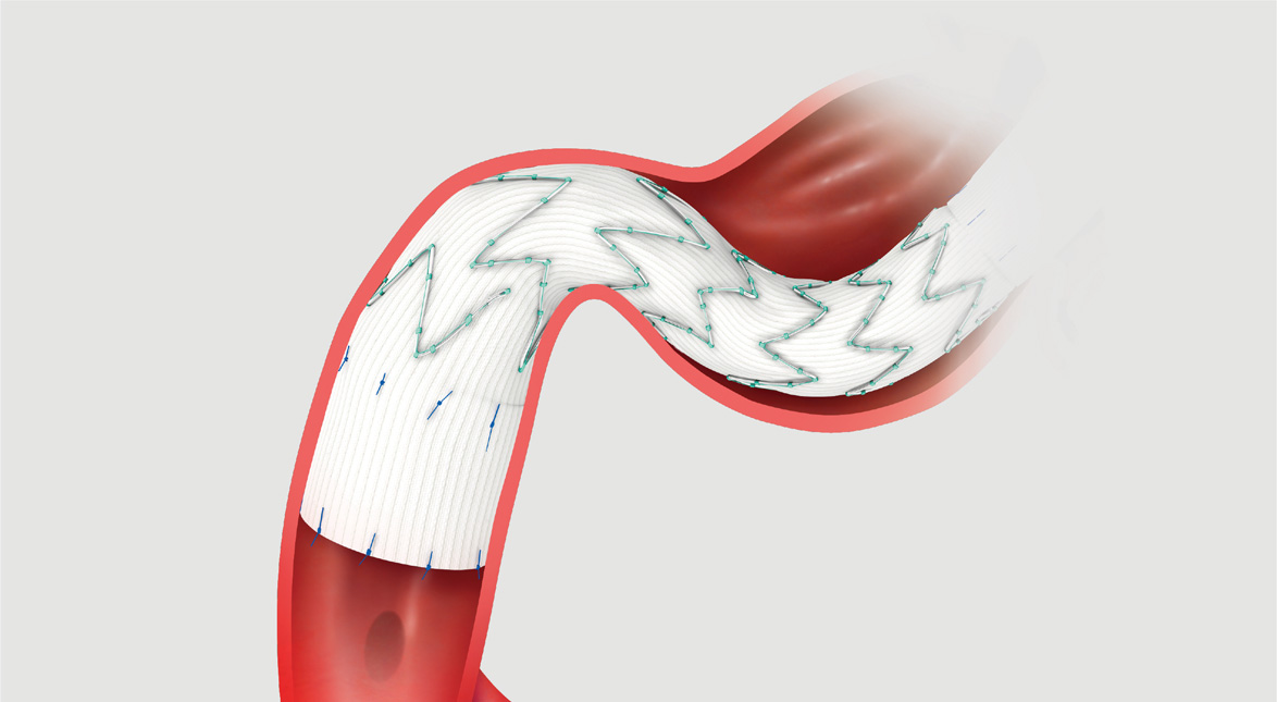Illustration of Zenith® Spiral-Z® AAA Iliac Leg Graft in curved iliac anatomy.