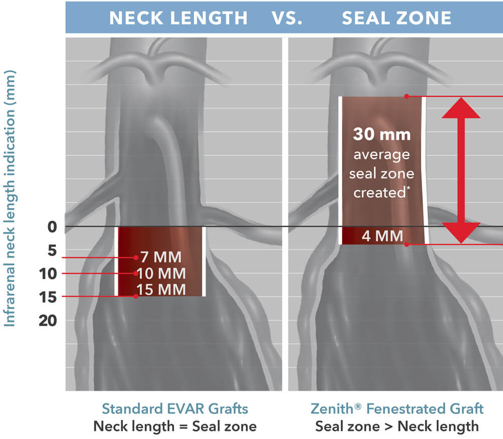 Chart comparing Zenith® Fenestrated graft to standard EVAR grafts, showcasing the Zenith® Fenestrated’s increased seal zone compared to its neck length – a 30 mm seal zone with a 4 mm neck length compared to the standard 7, 10, or 15 mm seal zone with the same neck length.