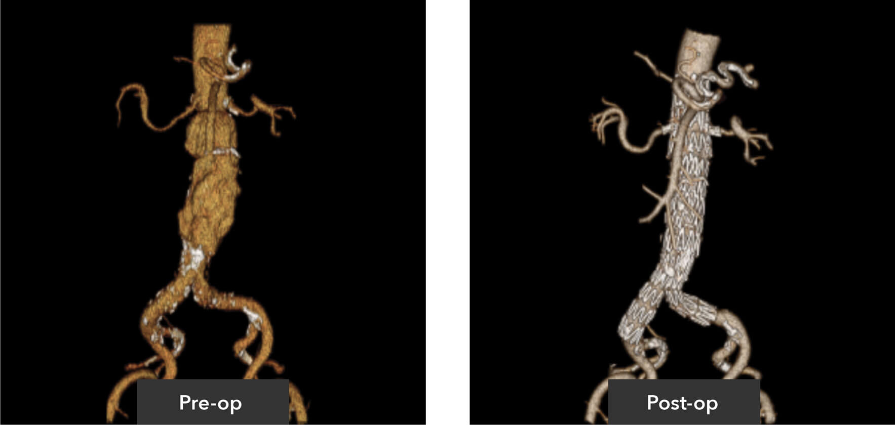 Pre-op scan of patient aortic anatomy. and Post-op scan of patient aortic anatomy with Zenith® Fenestrated and Zenith® Spiral-Z® iliac leg endovascular graft system inserted.