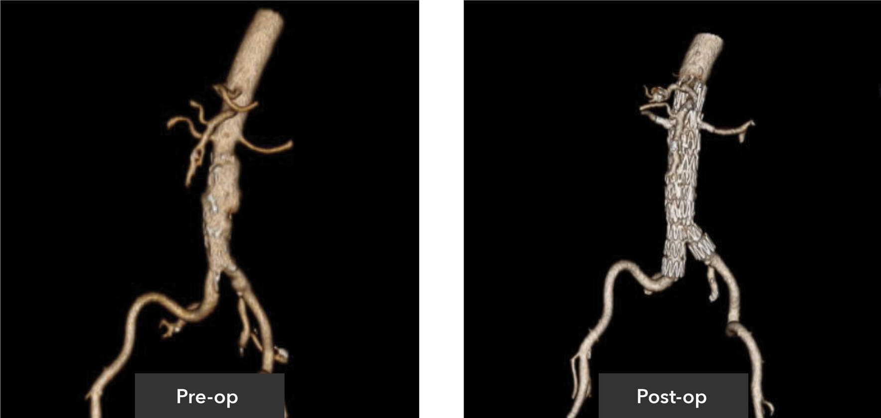 Pre-op scan of patient aortic anatomy. and Post-op scan of patient aortic anatomy with Zenith® Fenestrated and Zenith® Spiral-Z® iliac leg endovascular graft system inserted.