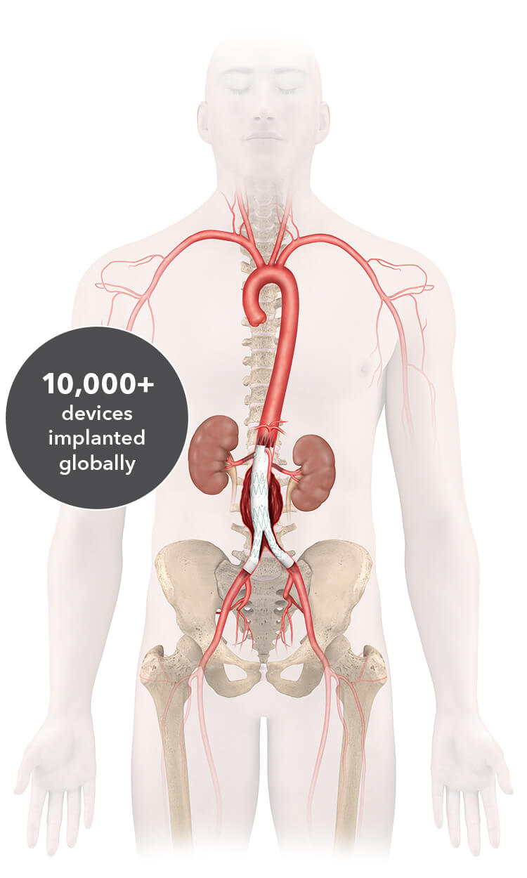 Human body showing aortic anatomy and an implanted endovascular graft.