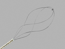 NCircle®; Helical Tipless Stone Extractor