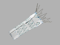 Zenith Fenestrated AAA Proximal Body Graft