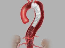 Zenith® Dissection Endovascular System in Anatomy