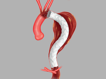 Zenith Alpha® 2 Thoracic Endovascular Graft in Anatomy