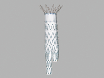 Zenith Flex AAA Endovascular Graft Main Body