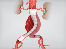 Zenith Renu AAA Ancillary Converter in Anatomy