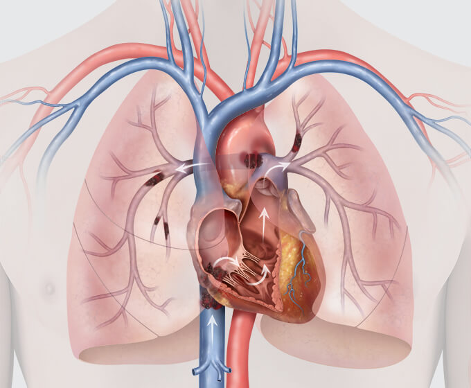 Causes and risks of PE