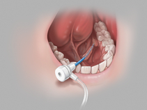 Kolenda Introducer Sheath