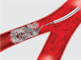 Image of Interventional Radiology