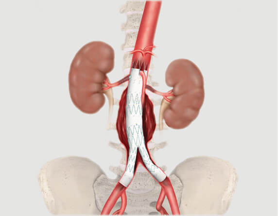 Illustration of aortic anatomy with Zenith® Fenestrated endovascular graft system inserted.