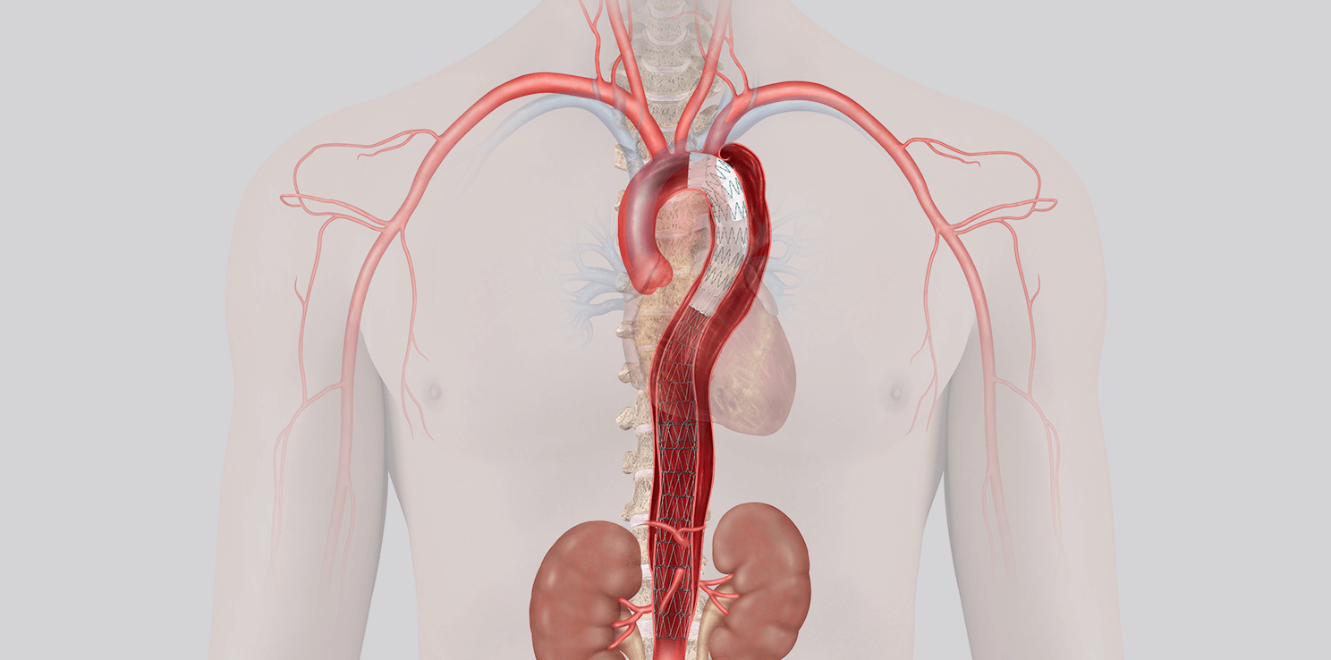 Illustration of vascular anatomy of human chest area, with Zenith® Dissection Endovascular System in the upper aorta.