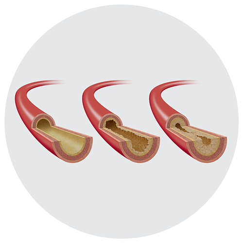 Peripheral arterial disease (PAD)