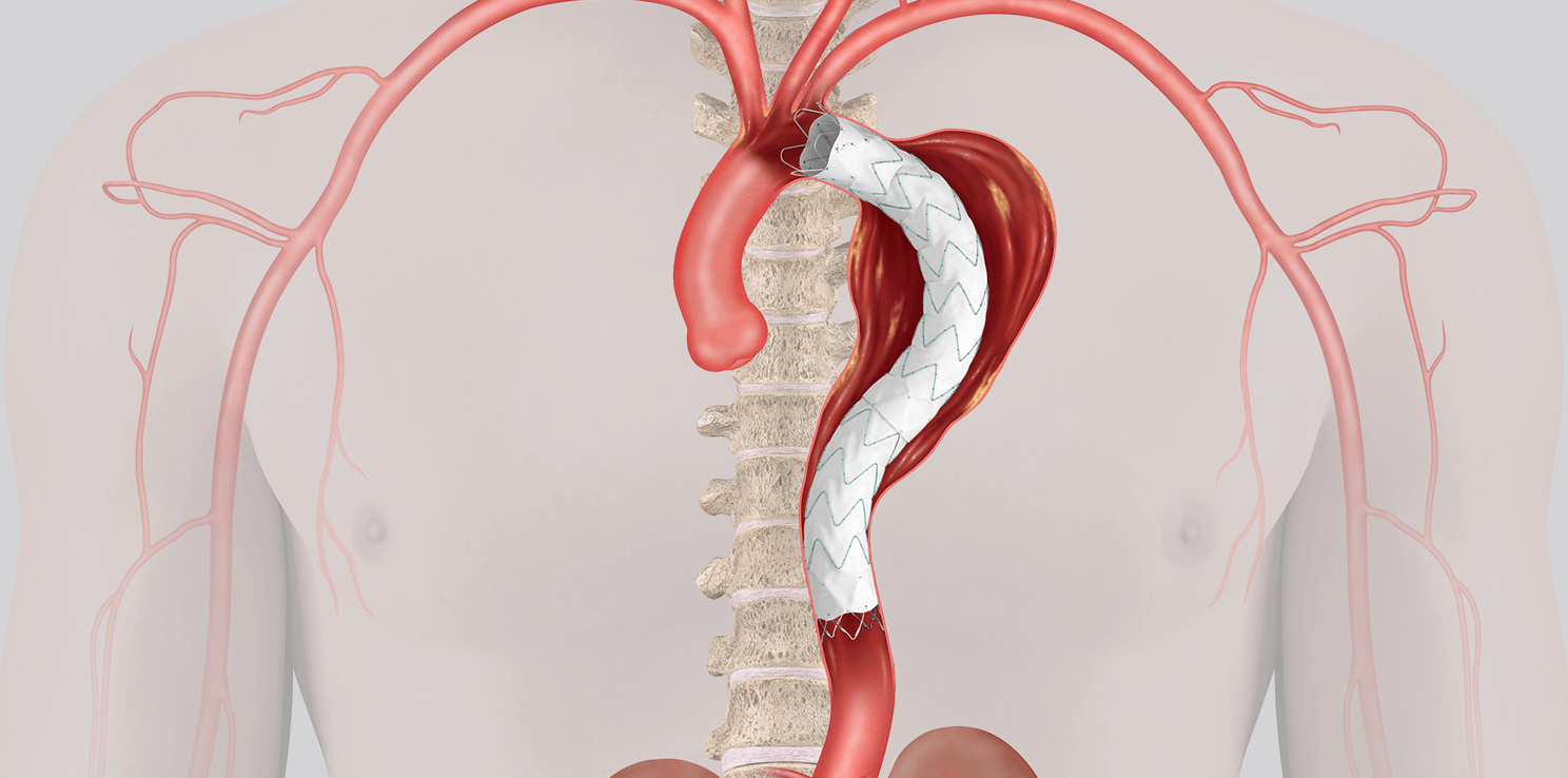 Illustration of vascular anatomy of human chest area, with Zenith Alpha® Thoracic Endovascular Graft in the upper aorta.